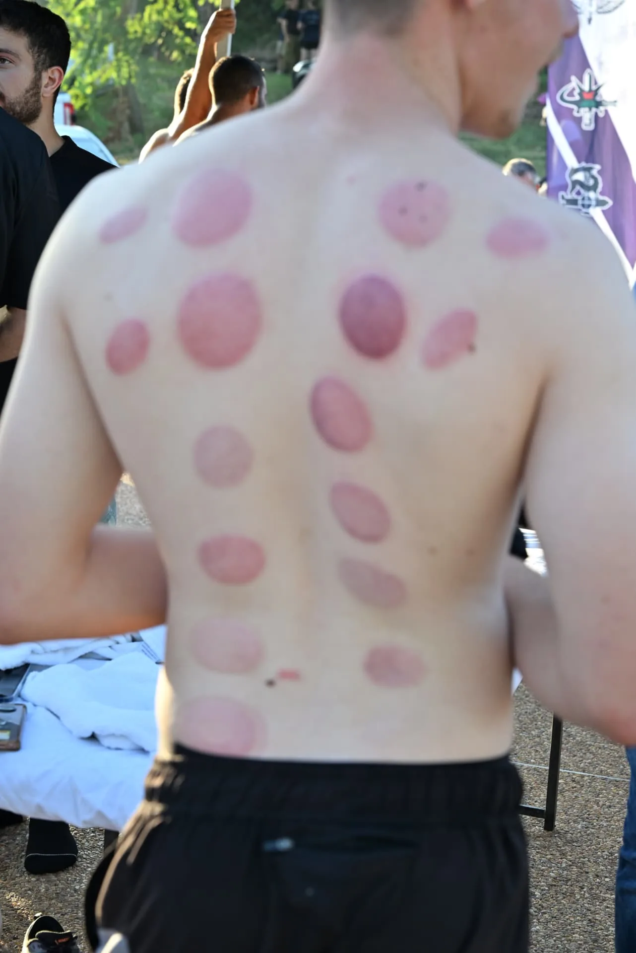 Cupping therapy marks after treatment for a soldier