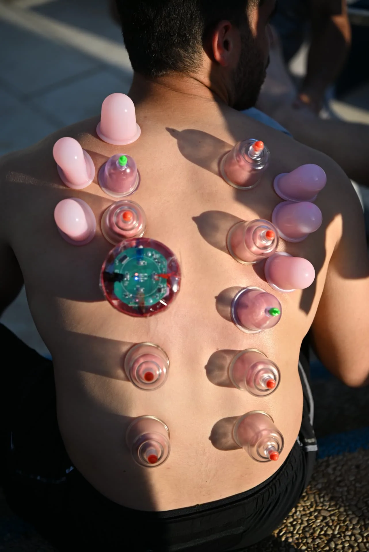 Cupping therapy treatment for a soldier